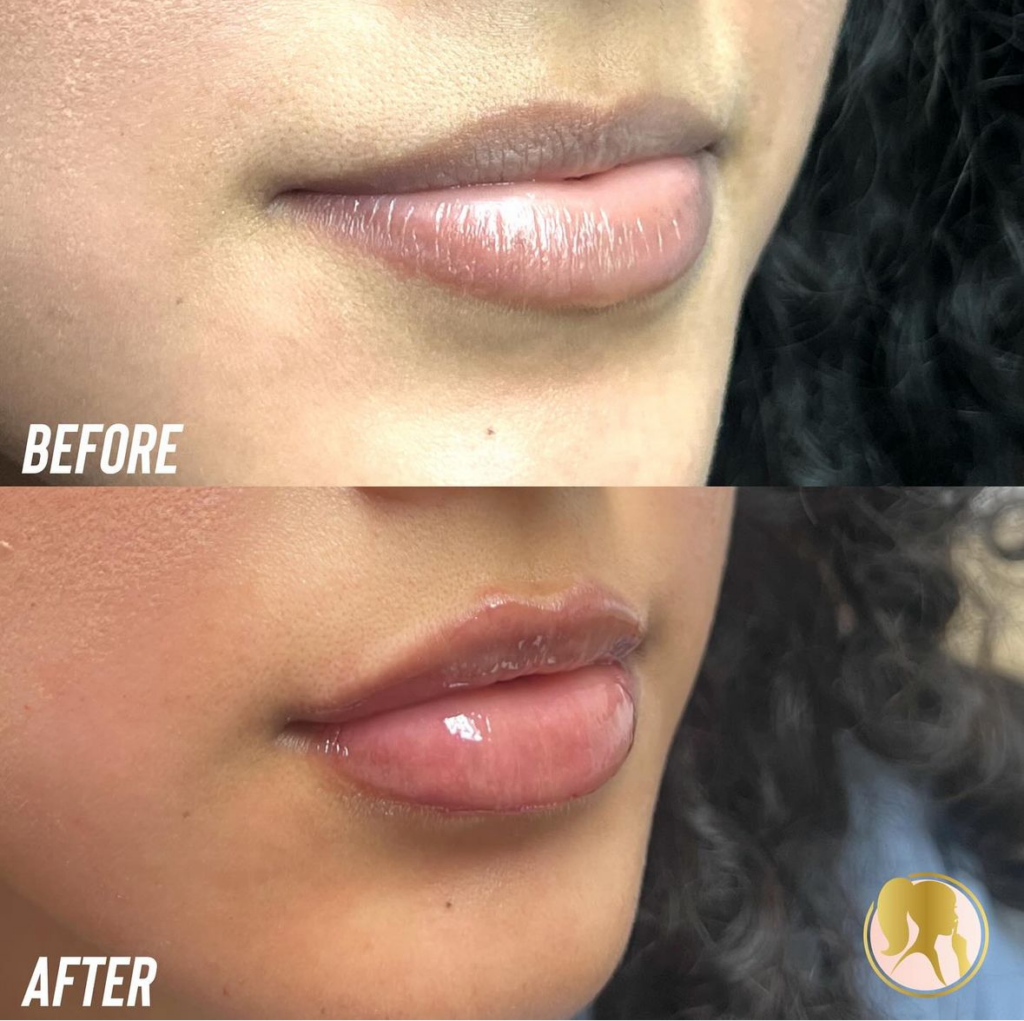 lip injections Los Angeles